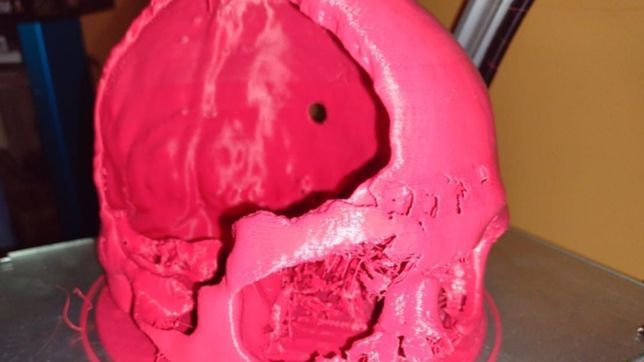 la utn platense creo una protesis craneana para un paciente con fractura y desprendimiento