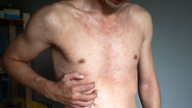 ¿cuales son los sintomas y como se contagia la viruela del mono que ya esta en argentina?