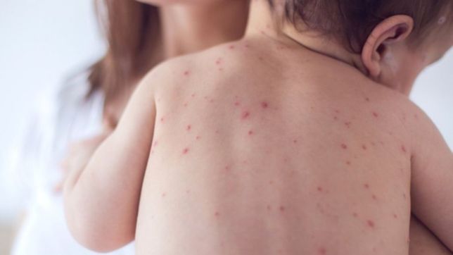 despues de 20 anos, estudian un posible caso de sarampion en la plata en una nena de 9 meses