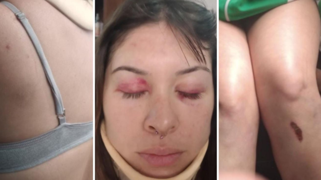 una chica denuncio que los patovicas de hogans la desfiguraron: estoy viva de milagro