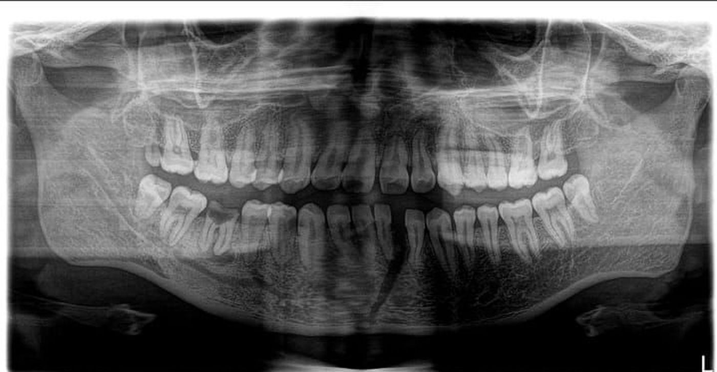 La placa que muestra la fractura de mandíbula que sufrió el joven de La Plata