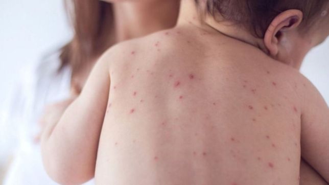 descartaron que tenga sarampion la beba que estuvo internada en la plata