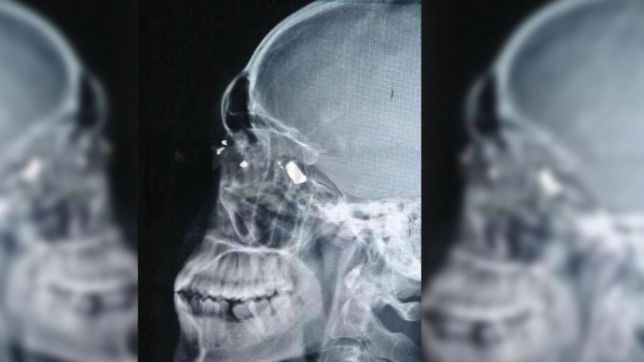 discutieron por una caja de vino, le dispararon en la cabeza y recibio el alta al otro dia