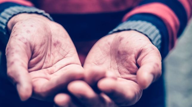 la oms activo su maximo nivel de alerta para contener el brote de viruela del mono