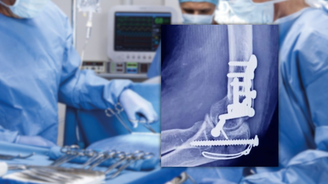 alerta de la anmat por un tornillo falsificado para cirugias traumatologicas