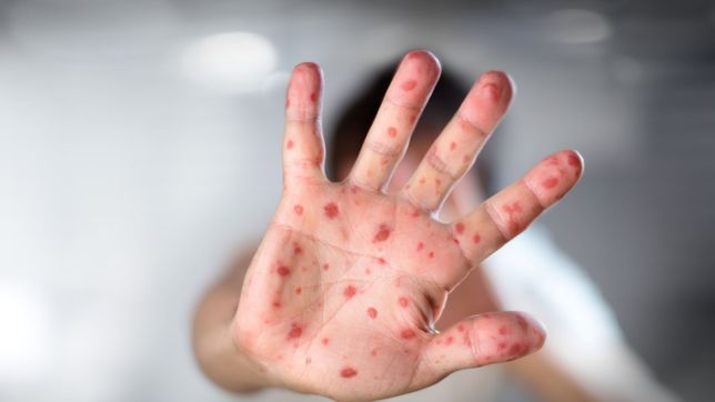 ¿como se prepara la plata para enfrentar posibles casos de sarampion?