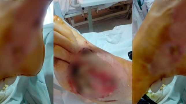 el desesperado pedido de una mujer platense para que no le amputen el pie
