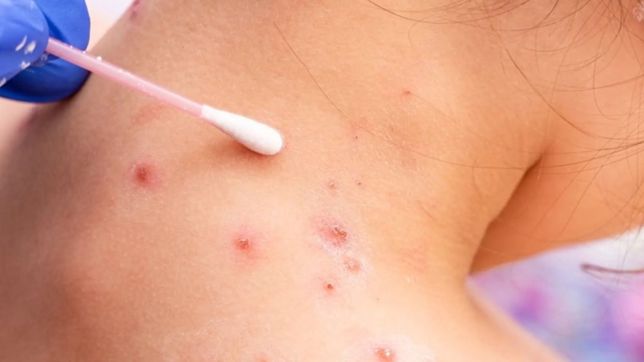 provincia confirmo que sigue de cerca el brote de viruela del mono que alerta al mundo