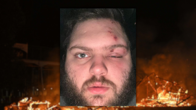 un joven resulto herido en la quema de un muneco y perdio parte de la vision de un ojo